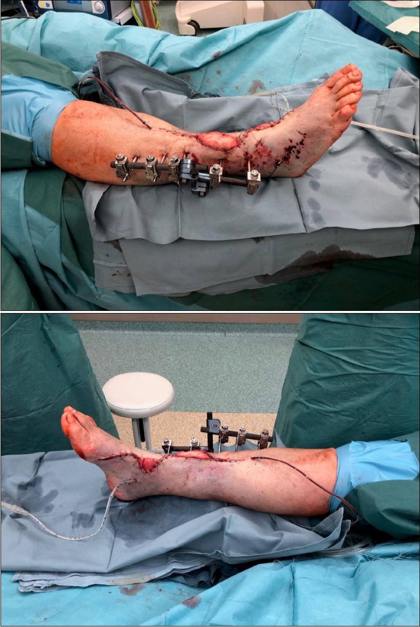high energy injury