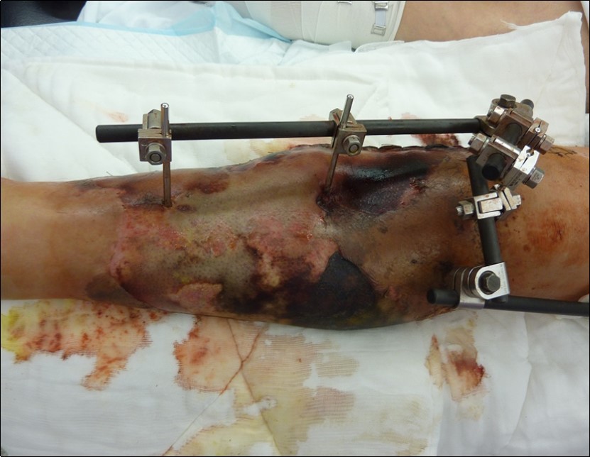 high energy injury