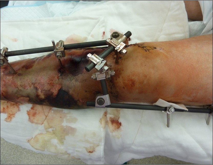high energy injury