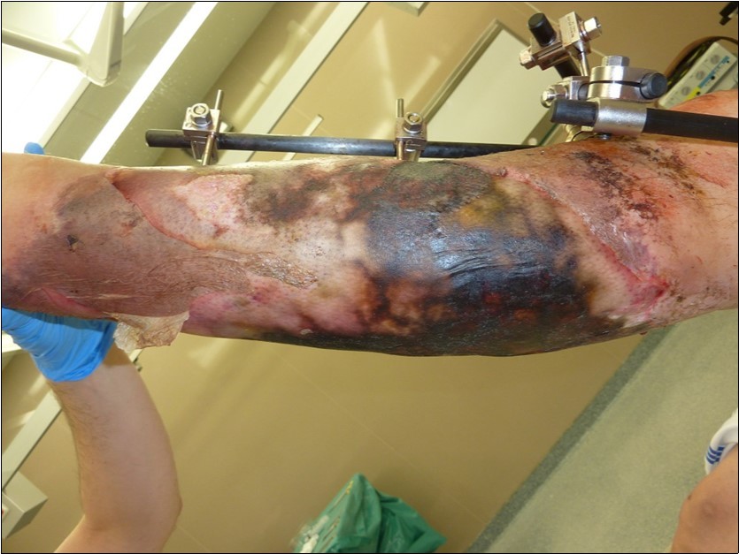 high energy injury