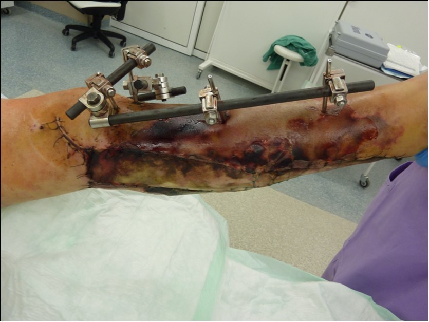 high energy injury