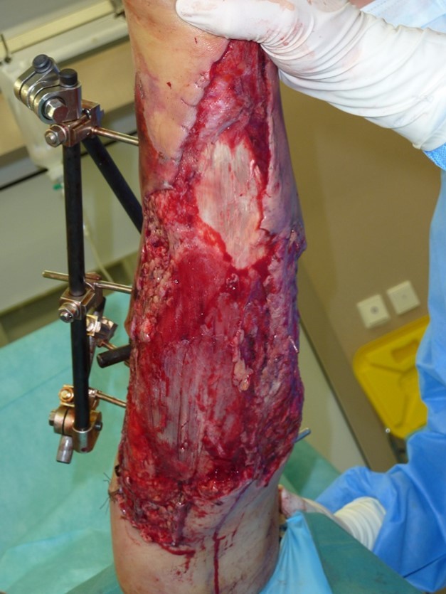 high energy injury