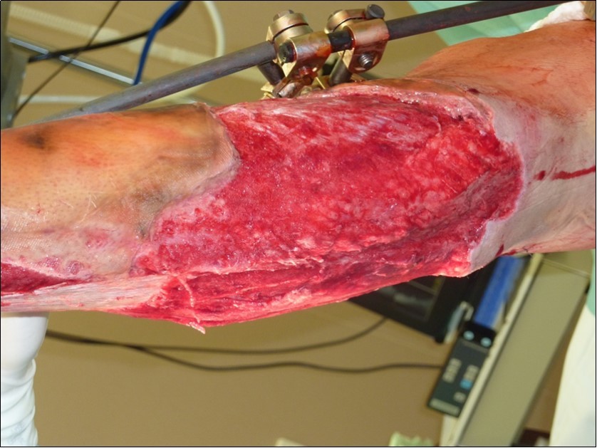 high energy injury