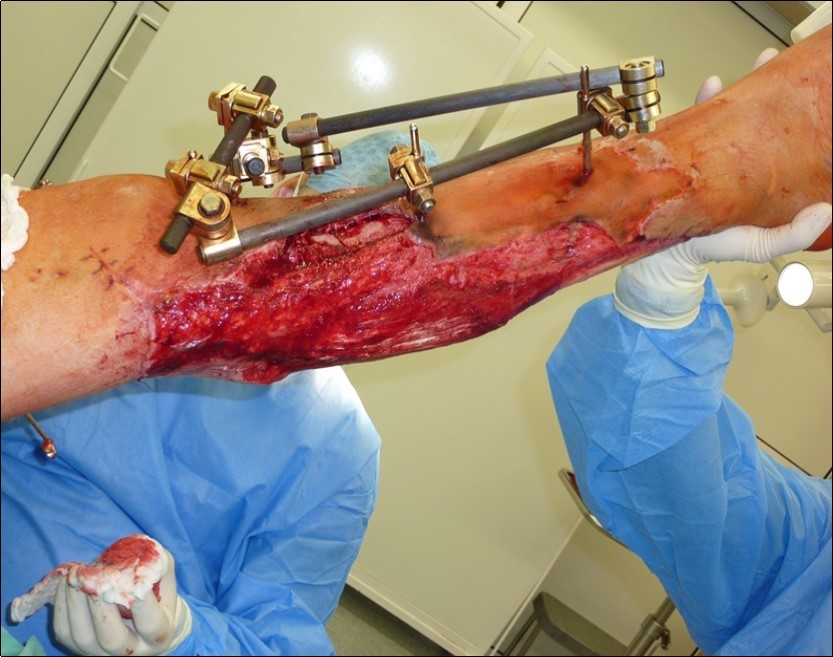 high energy injury