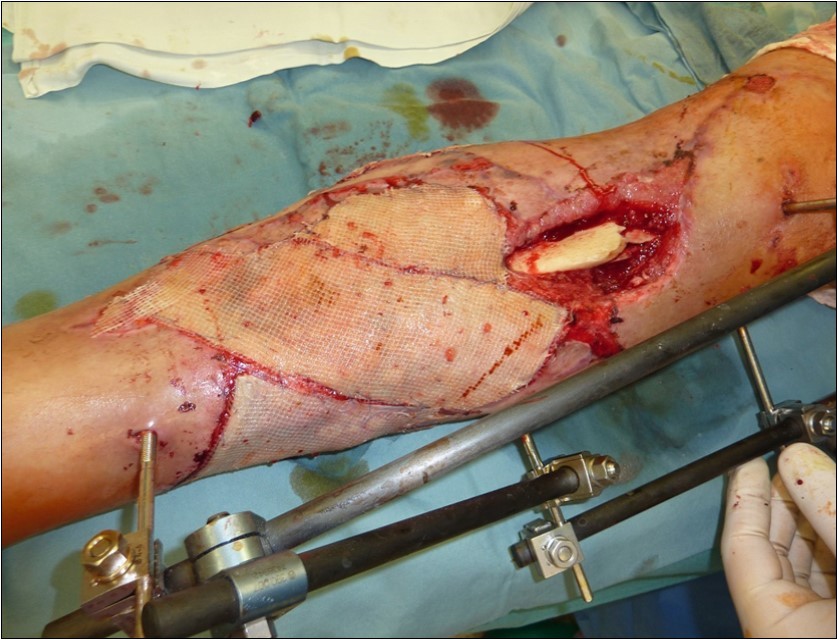 high energy injury