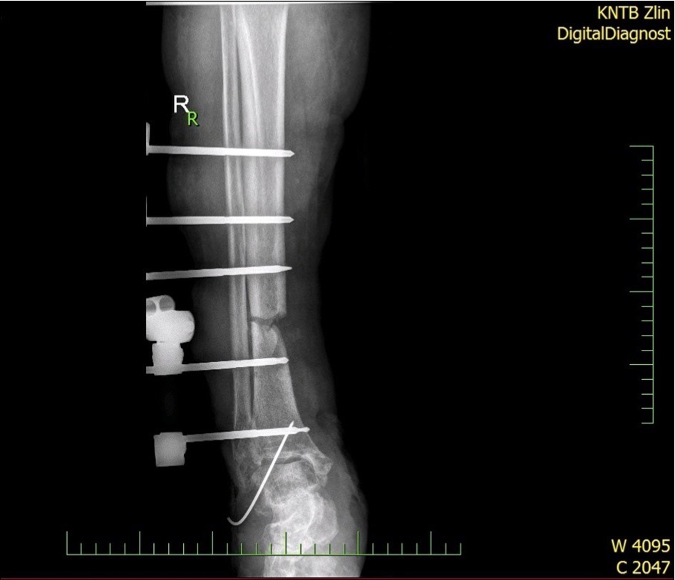 high energy injury