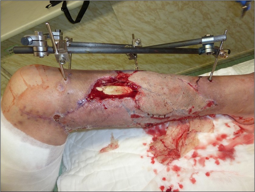 high energy injury