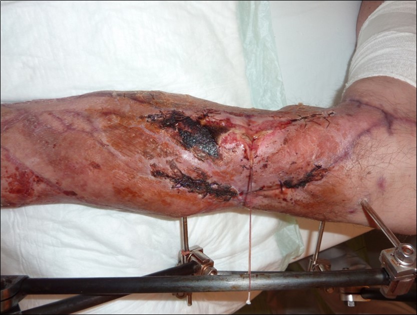 high energy injury