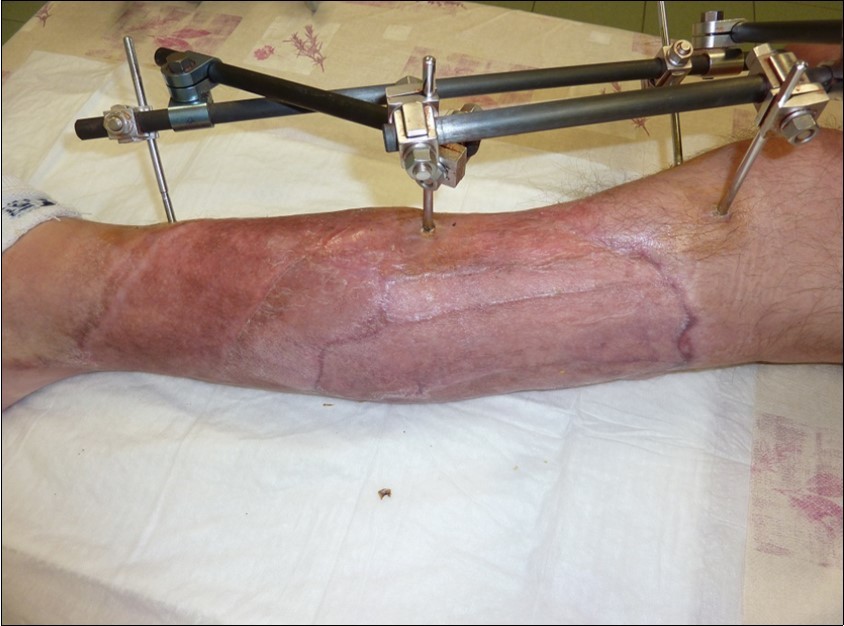 high energy injury