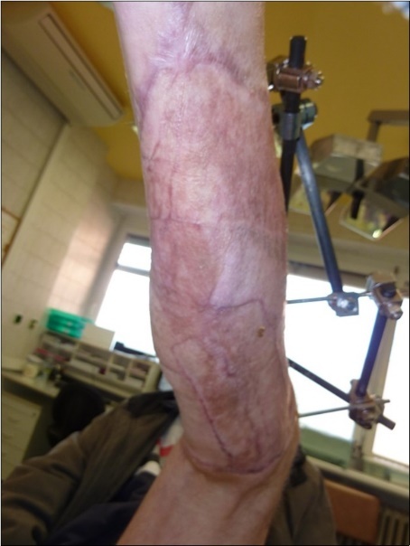 high energy injury