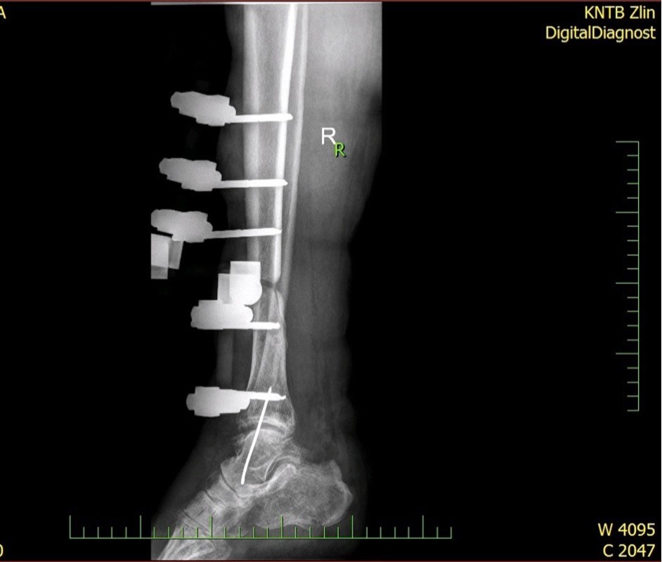 high energy injury