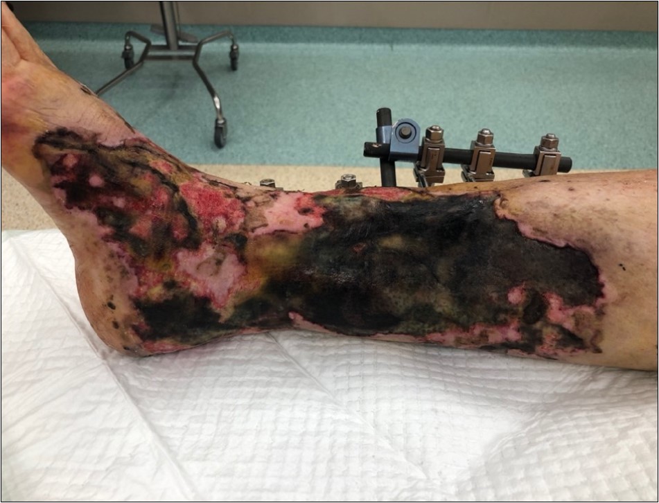 high energy injury