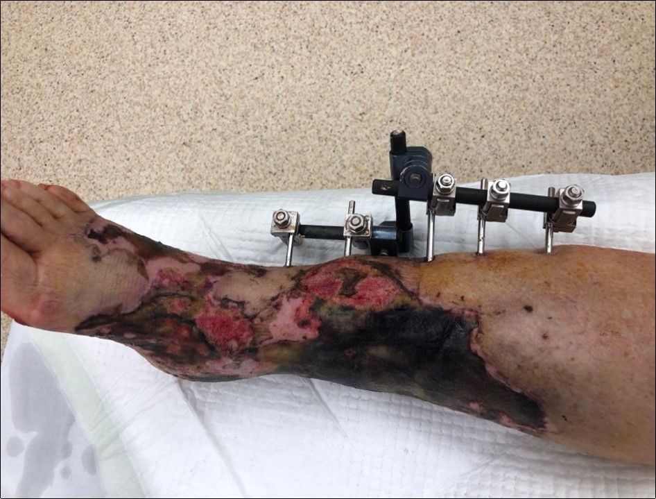 high energy injury