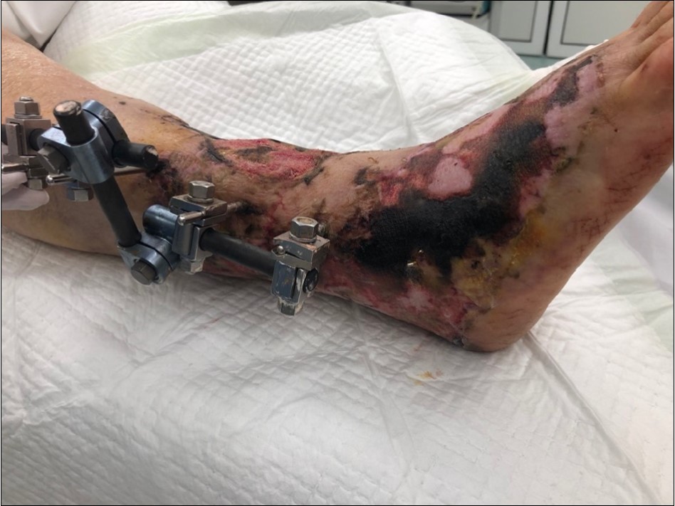 high energy injury
