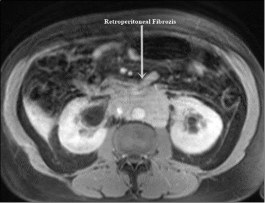Journal of Clinical Case reports and Images-Retroperitoneal Fibrosis