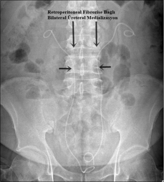 Journal of Clinical Case reports and Images-Retroperitoneal Fibrosis