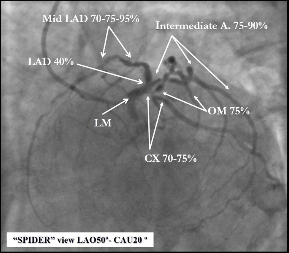 Journal of Clinical Case reports and Images-Percutaneous coronary intervention (PCI)