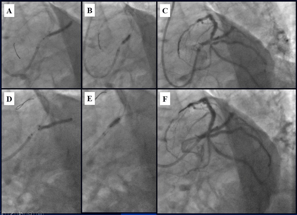 Journal of Clinical Case reports and Images-Percutaneous coronary intervention (PCI)