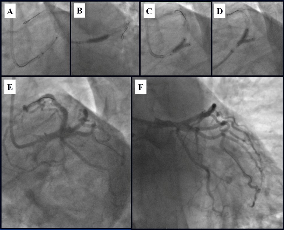 Journal of Clinical Case reports and Images-Percutaneous coronary intervention (PCI)