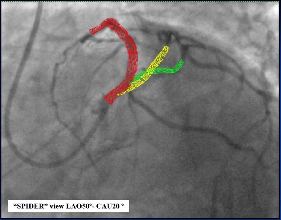 Journal of Clinical Case reports and Images-Percutaneous coronary intervention (PCI)