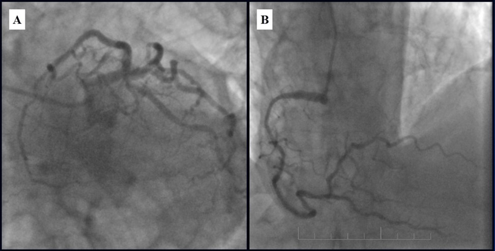 Journal of Clinical Case reports and Images-Percutaneous coronary intervention (PCI)