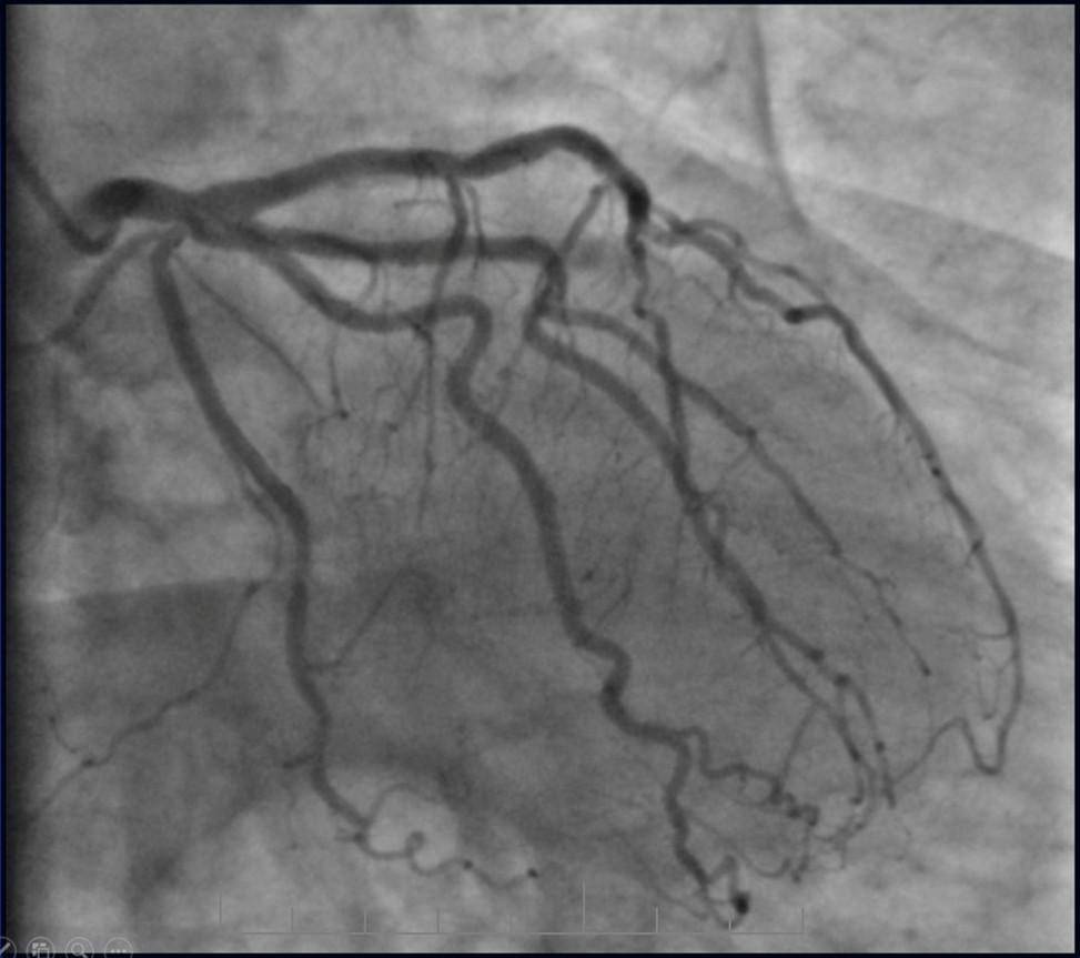 Journal of Clinical Case reports and Images-Percutaneous coronary intervention (PCI)