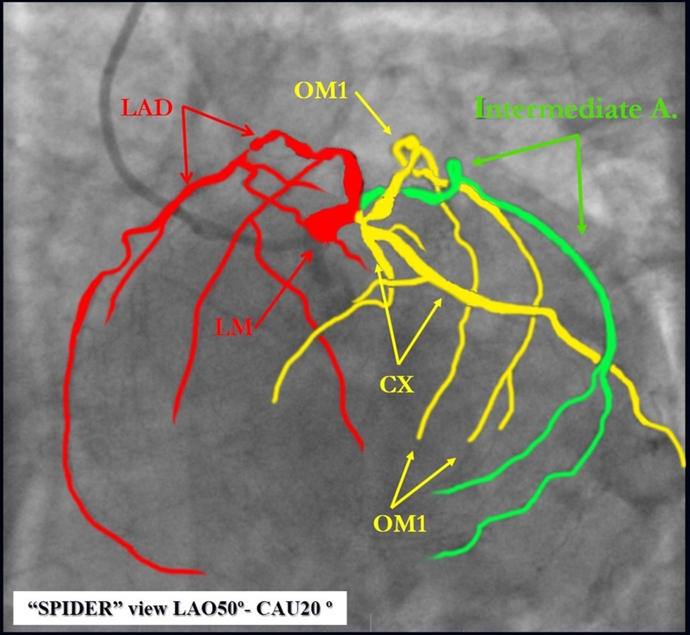 Journal of Clinical Case reports and Images-Percutaneous coronary intervention (PCI)