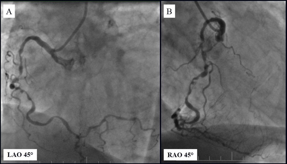 Journal of Clinical Case reports and Images-Percutaneous coronary intervention (PCI)