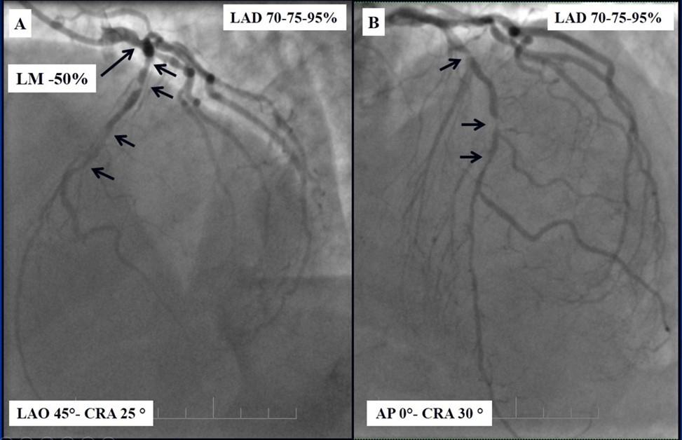 Journal of Clinical Case reports and Images-Percutaneous coronary intervention (PCI)