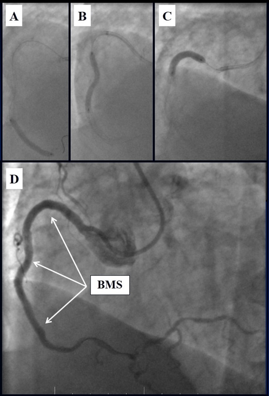 Journal of Clinical Case reports and Images-Percutaneous coronary intervention (PCI)