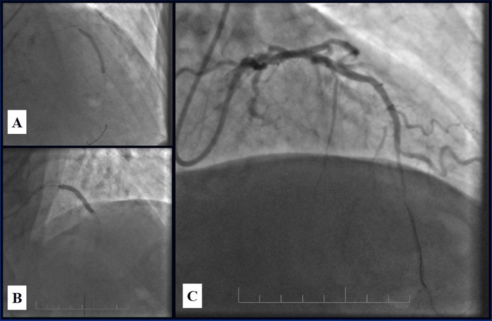 Journal of Clinical Case reports and Images-Percutaneous coronary intervention (PCI)