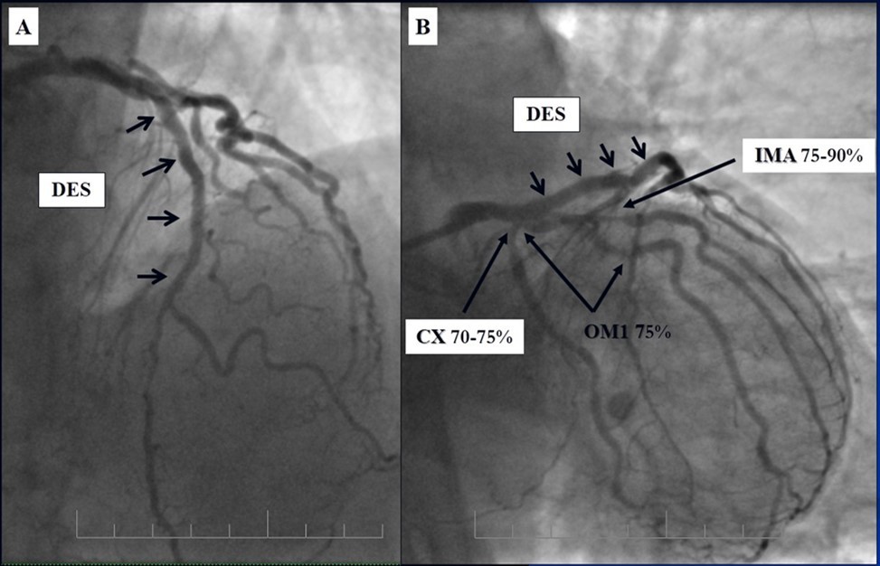 Journal of Clinical Case reports and Images-Percutaneous coronary intervention (PCI)