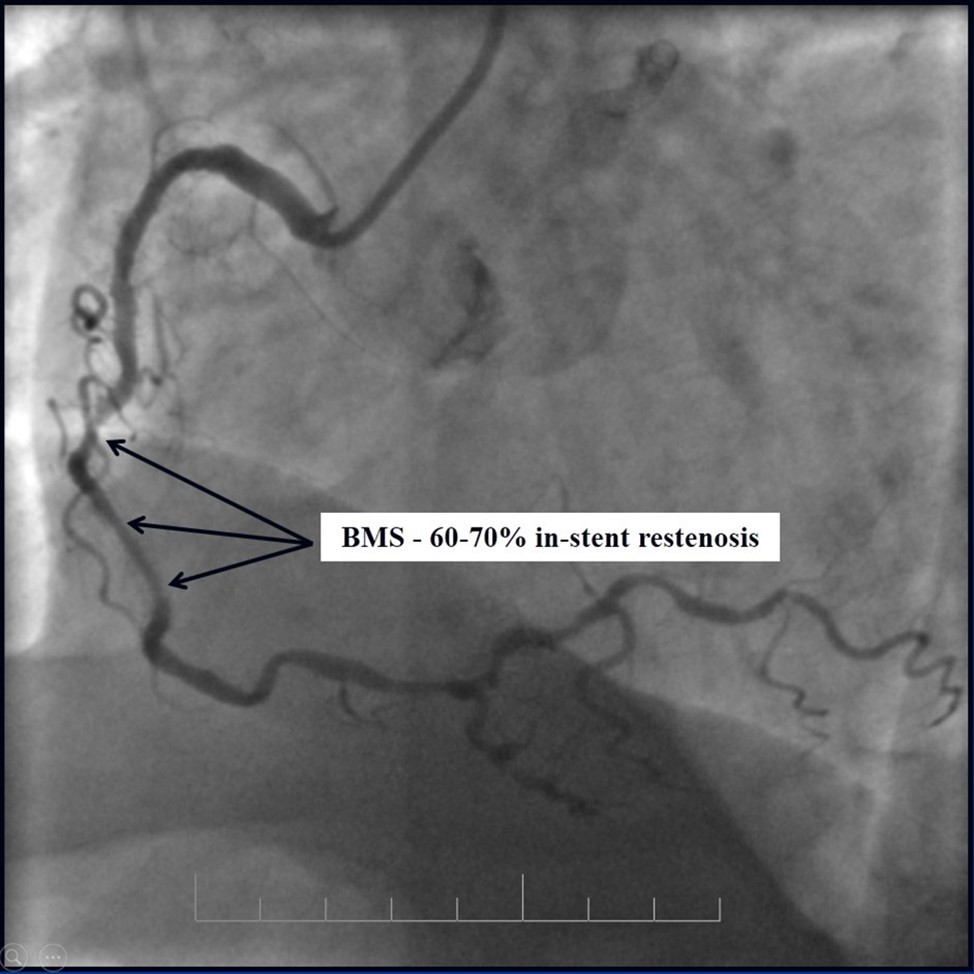 Journal of Clinical Case reports and Images-Percutaneous coronary intervention (PCI)