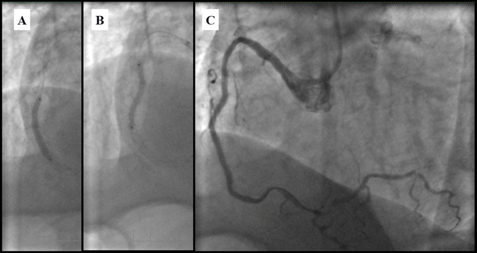 Journal of Clinical Case reports and Images-Percutaneous coronary intervention (PCI)
