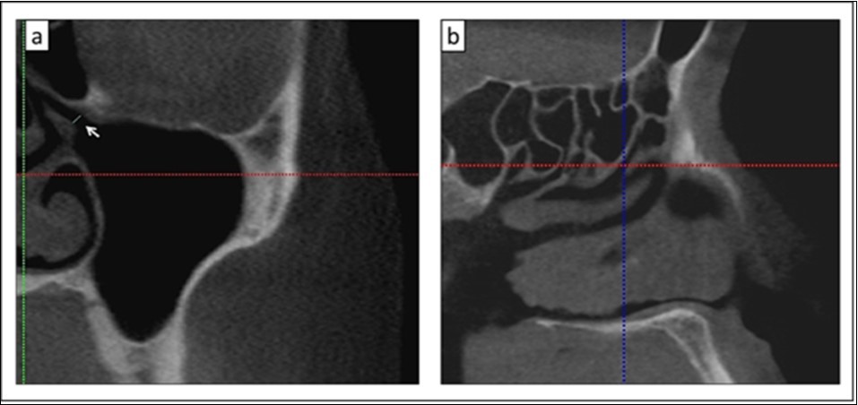 Journal of Big Data Research-Primary maxillary sinus ostium