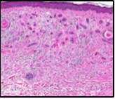 Desmoplastic trichoepithelioma exhibiting accumulated basaloid epithelial cells disseminated amongst a background of abundant fibrous tissue stroma and an attenuated superimposed epidermis 10.