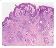 Desmoplastic trichoepithelioma enunciating several horn cysts, nests of basaloid cells, an enveloping desmoplastic stroma and thinned out superimposed epithelium 12.