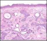 Desmoplastic trichoepithelioma exemplifying several keratinous horn cysts, nests of basaloid cells, a desmoplastic fibrotic stroma along with a thinned out squamous epithelial lining 14.