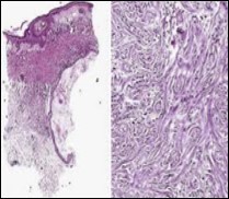 Desmoplastic fibrotic stroma demonstrating a thinned out, superimposed epithelium, fibrotic stroma and a dispersal of basaloid cell cords and aggregates 15.