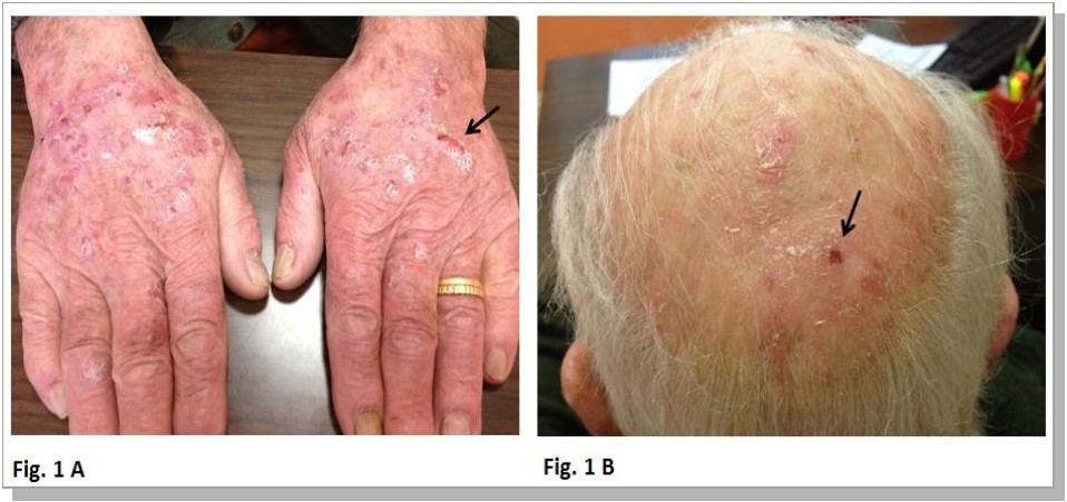 Journal of Hematology and Oncology Research-Hydroxyurea