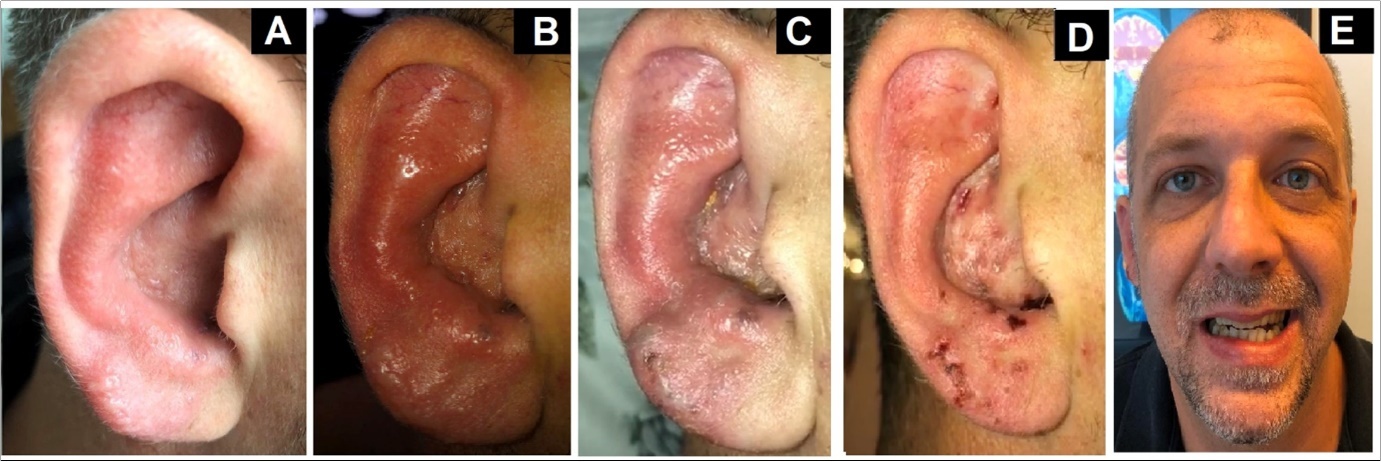 Right Auricle varicella zoster vesicles. (A) Third day of clinical evolution (B) Seventh day of clinical evolution (C) Tenth day of clinical evolution (D) Fifteenth day of clinical evolution (E) Right facial nerve paralysis- House Brackmann scale grade II.