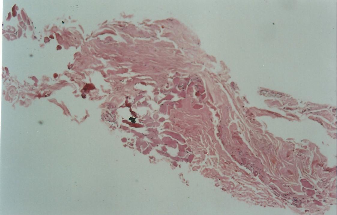 Journal of Otolaryngology Advances-Tympanoplasty