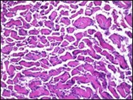 Journal of Dermatologic Research And Therapy-Papillary Endothelial Hyperplasia