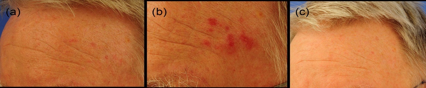 Journal of Dermatologic Research And Therapy-basal cell carcinoma (BCC)
