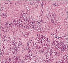 Fibromatosis colli depicting clusters of spindle-shaped cells, plump fibroblasts and comingled mature skeletal muscle fibres with collagen-rich stroma 13.