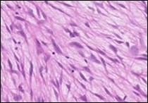 Low grade fibromyxoid sarcoma enunciating fibrous and myxoid zones of uniform spindle-shaped tumour cells with absence of atypia 9.