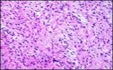 Low grade fibromyxoid sarcoma exemplifying intermingled foci of fibrous and myxoid regions of spindle-shaped cells with minimal pleomorphism and absence of mitosis (10).