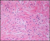 Low grade fibromyxoid sarcoma exhibiting alternating fibrous and myxoid zones composed of spindle-shaped tumour cells (13).