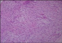 Low grade fibromyxoid sarcoma delineating alternating fibrous and myxoid areas of minimal cellularity and mitosis (9).
