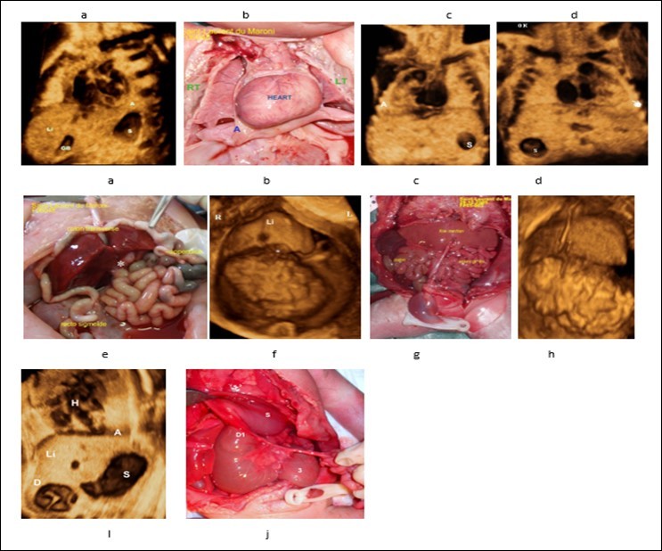 Journal of Clinical Case reports and Images-Heterotaxy